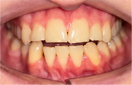 Close-up photo of upper and lower teeth slightly apart