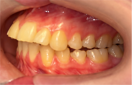 Close-up photo of the left side teeth