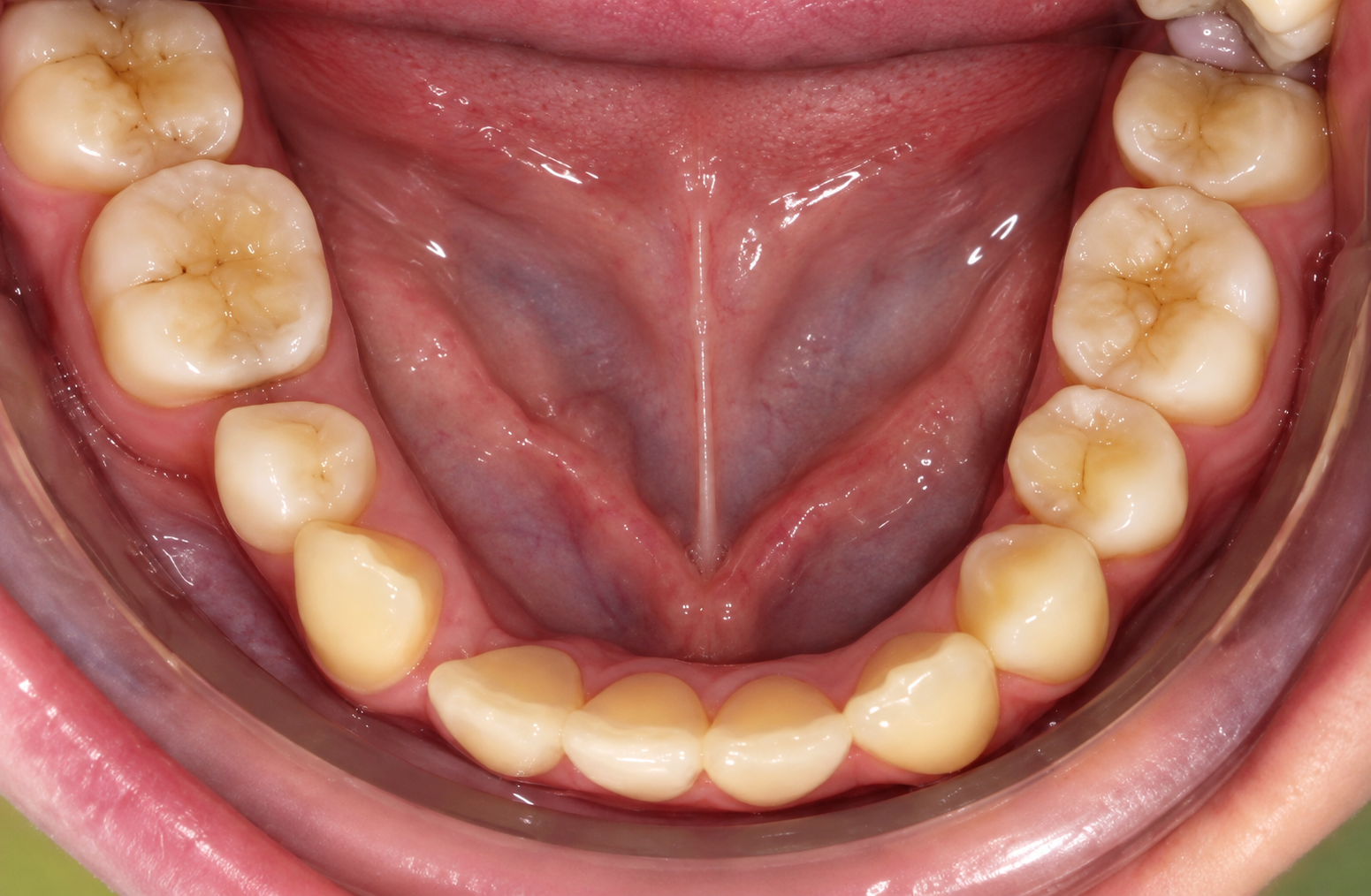 Close-up photo of the lower teeth and floor of the mouth
