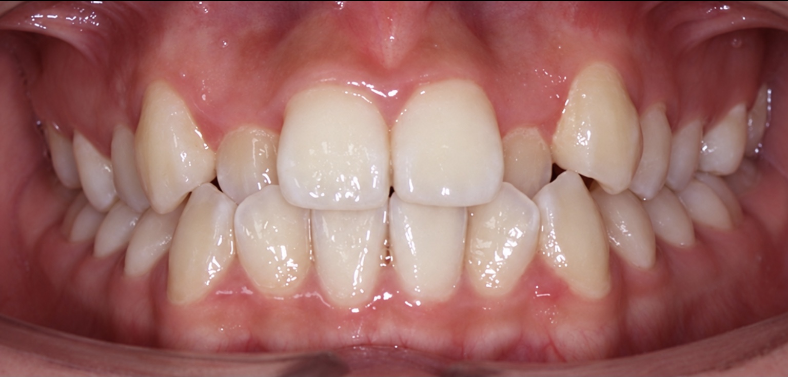 Smile gallery — Before