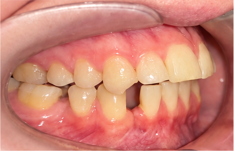 Close-up photo of the right side teeth