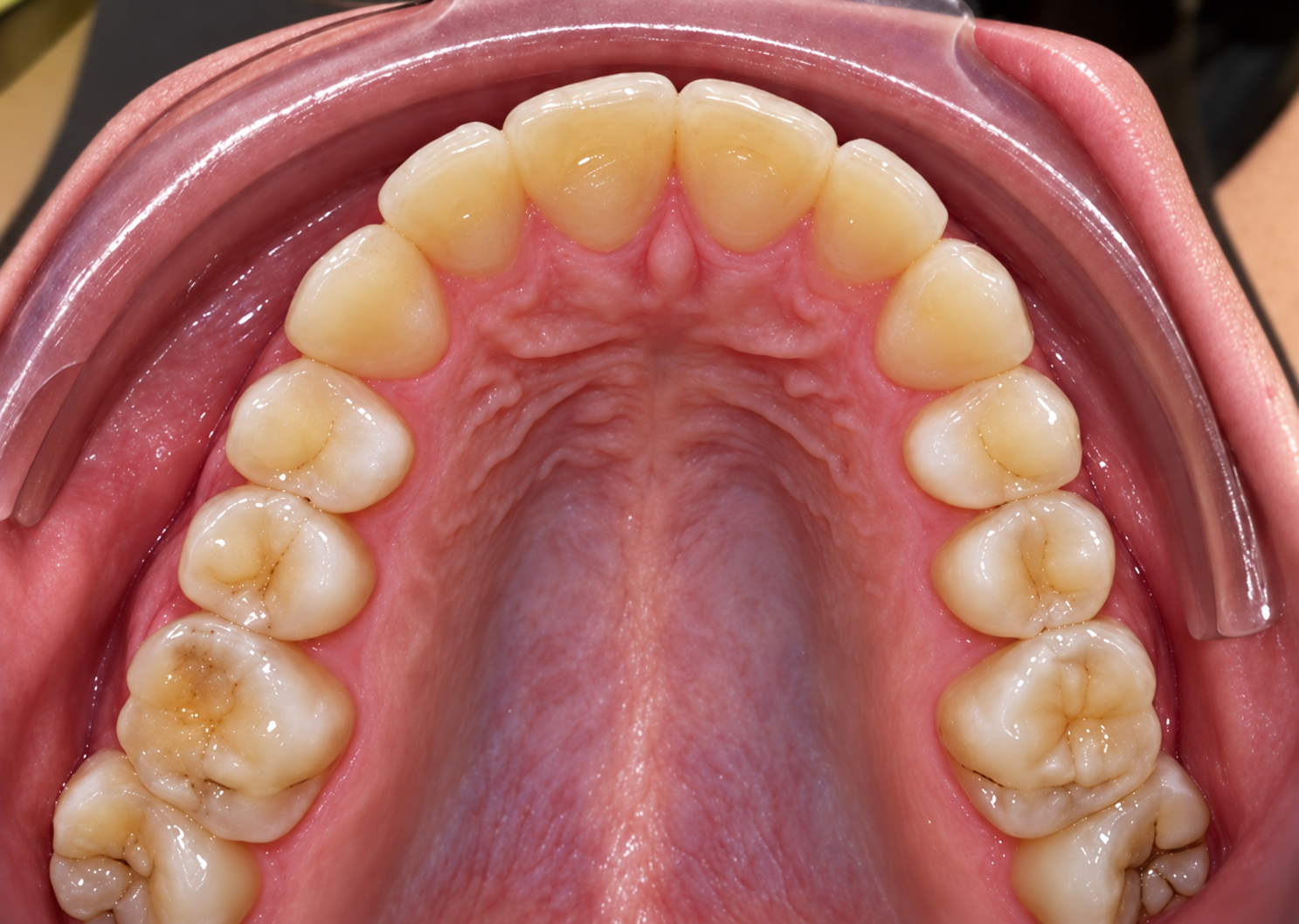 Close-up photo of the upper teeth and roof of the mouth