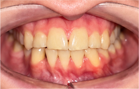 Close-up photo of teeth seen from the front